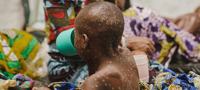 Two Cases of Mpox Confirmed in Kabale