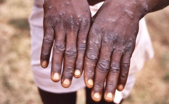 Arua Tracks 52 Contacts Linked to First Mpox Case